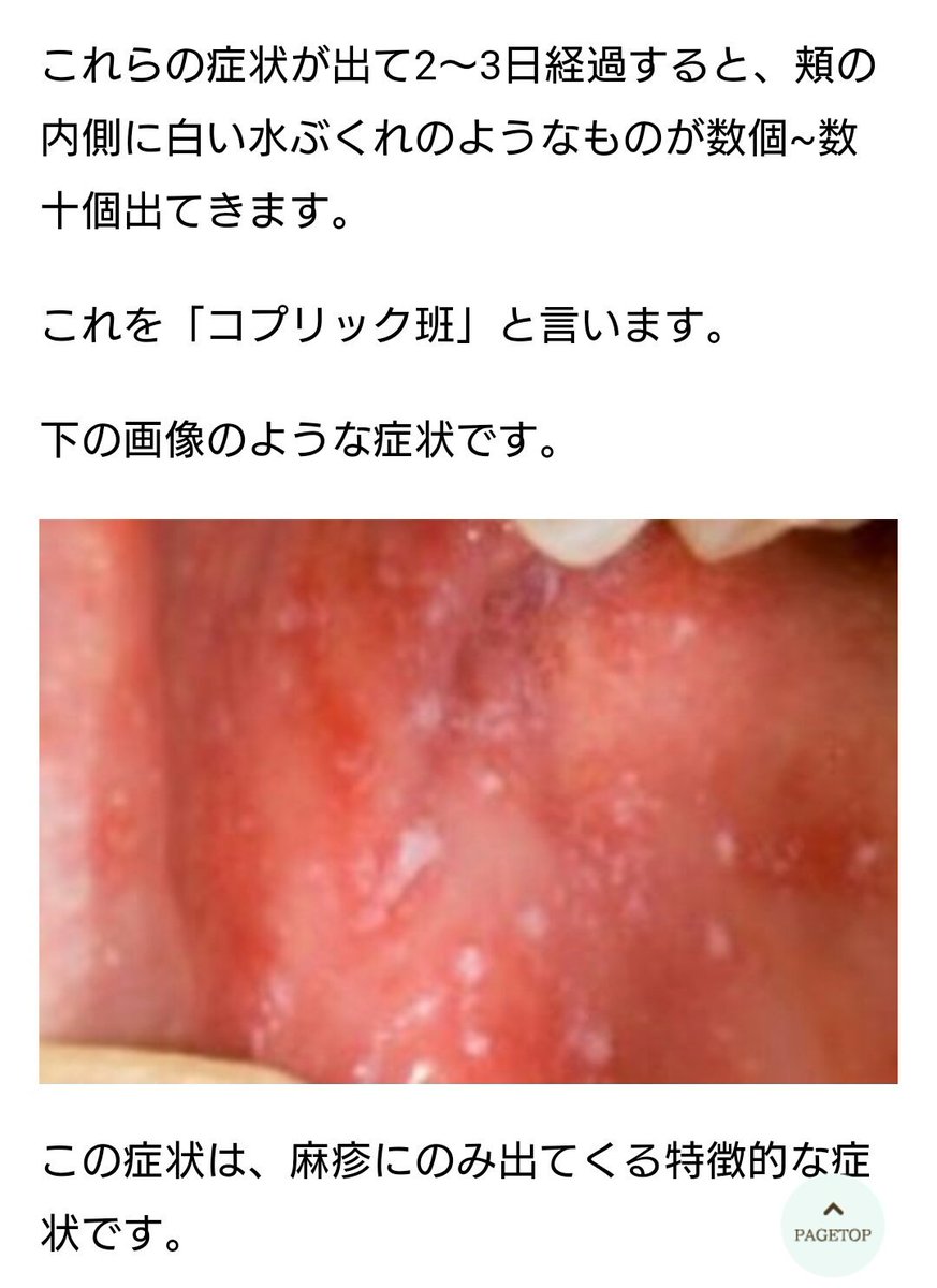 感染症情報ひろば 大人の 麻疹 はしか の初期症状 38 前後の熱 咳や鼻水くしゃみ等風邪のような症状 倦怠感 だるさ 結膜炎症状 光がまぶしい感じ 充血や目やに等 2 3日後 口内 ほおの内側 に白い水膨れのような物 耳の後ろ 首から