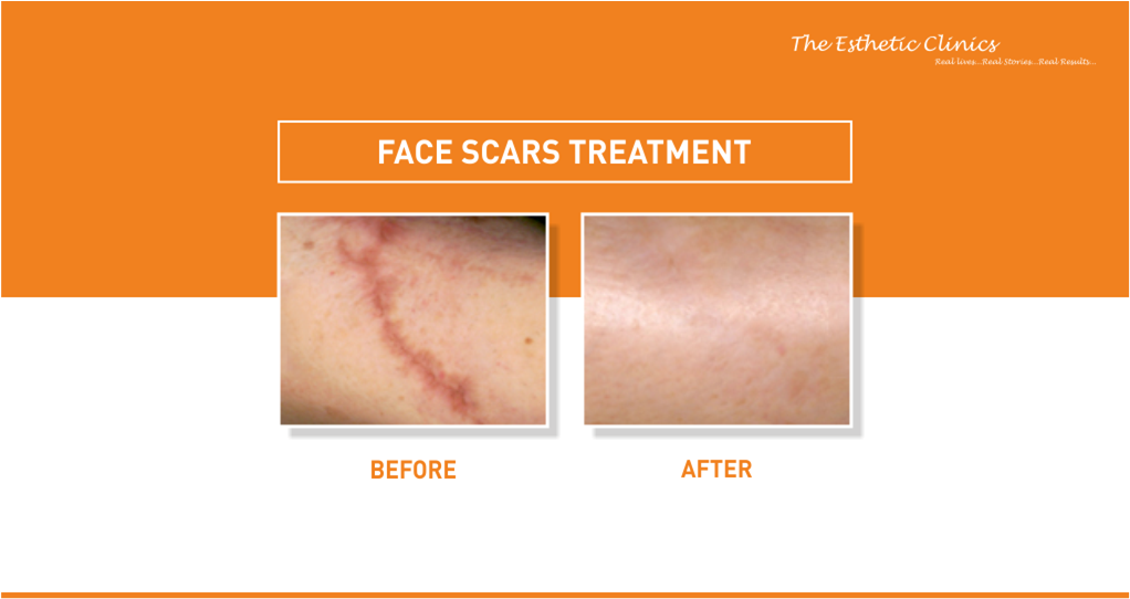 iamrinkykapoor's tweet photo. Make your #facescars invisible by reducing them significantly with latest technologies. Call to get your #facialscars reduced +91-22-33756374 

#TheEstheticClinics #DrRinkyKapoor #BestDermatologist #Skincare #SkinHealth #SkinGoals #Dermatologist https://t.co/6adH5xXp6O
