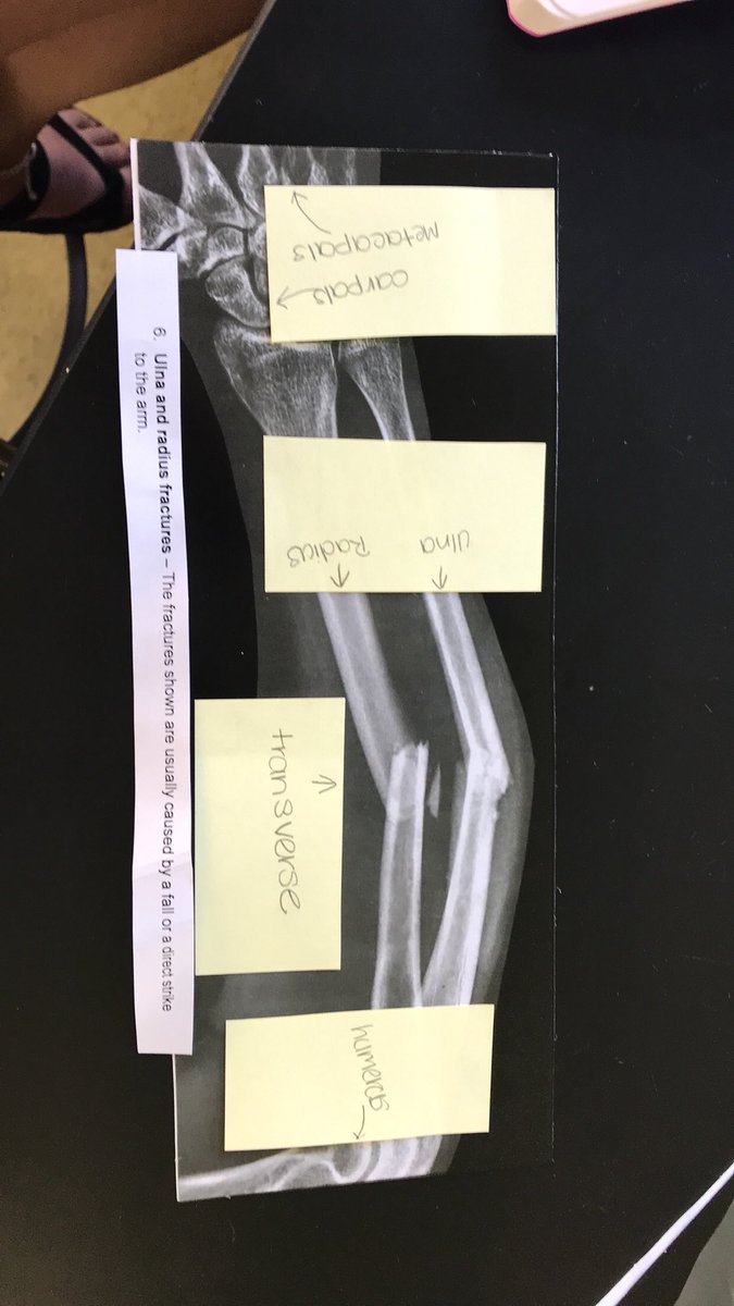 02Trotter's tweet photo. Fractures #rhsbms https://t.co/jgUNJq5iuF