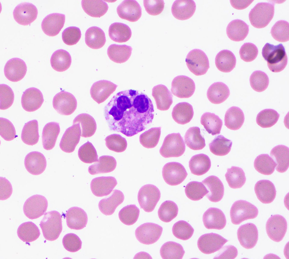 KDannheimMD's tweet photo. Summer is here! First smear of the season with a tick-born illness -- Anaplasma phagocytophilum! Did you know that the feathered edge is one of the best places to look for microorganisms? Morulae in the cytoplasm of granulocytes can be more easily visualized here.  #hemepath https://t.co/K85GqvwjAB