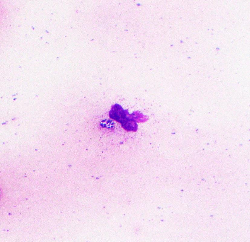 KDannheimMD's tweet photo. Summer is here! First smear of the season with a tick-born illness -- Anaplasma phagocytophilum! Did you know that the feathered edge is one of the best places to look for microorganisms? Morulae in the cytoplasm of granulocytes can be more easily visualized here.  #hemepath https://t.co/K85GqvwjAB