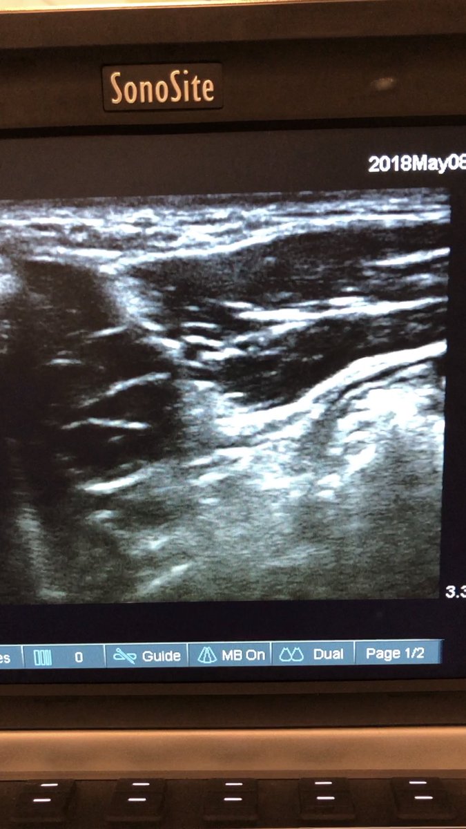 dr_tgro's tweet image. #suprainguinalFasciaIliacaBlock #USguided spread was similar to “bow-tie” method @ASRA_Society @Duke_Anesthesia @PennAnesthesia @nelkassabany @jeffgadsden @galusweegie video in next tweet -