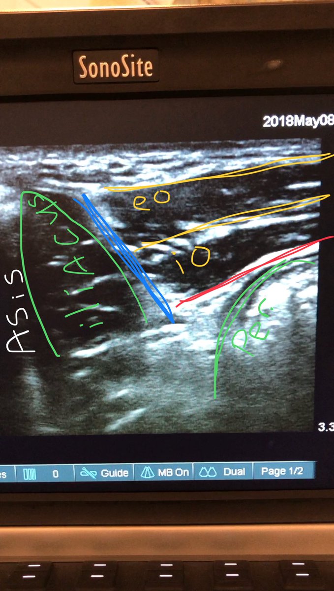 dr_tgro's tweet image. #suprainguinalFasciaIliacaBlock #USguided spread was similar to “bow-tie” method @ASRA_Society @Duke_Anesthesia @PennAnesthesia @nelkassabany @jeffgadsden @galusweegie video in next tweet -