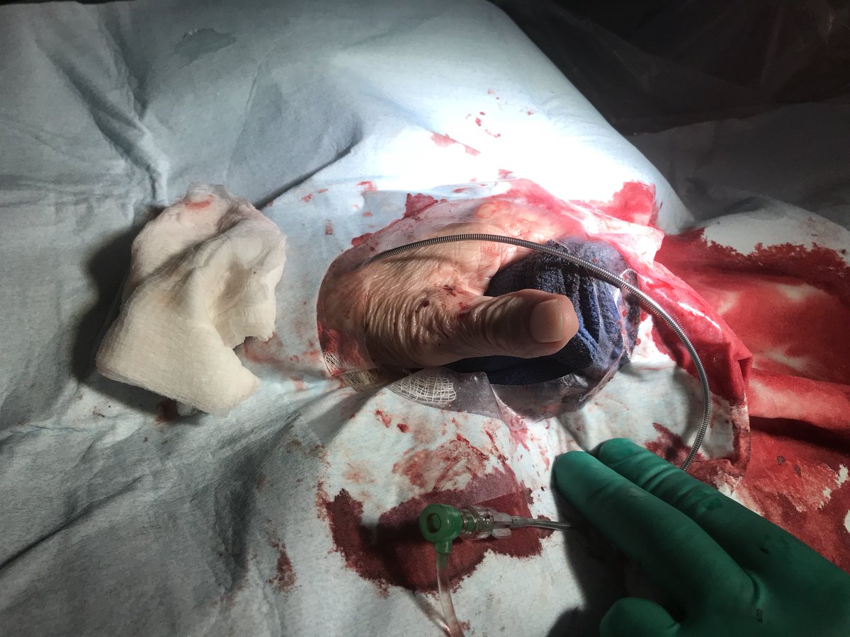 drmomani's tweet photo. We did our first distal left radial access to peripheral case today with 120 cm destination sheath, fixed an iliac #CTO. It was great! #R2P #Radialfirst #dltra @ArHeartHospital Dr Rollefson https://t.co/r2PyI0ZhNv