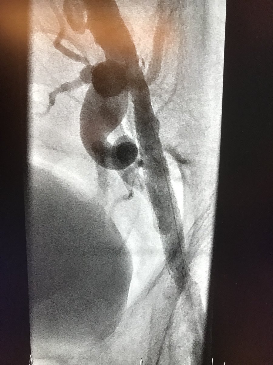 drmomani's tweet photo. We did our first distal left radial access to peripheral case today with 120 cm destination sheath, fixed an iliac #CTO. It was great! #R2P #Radialfirst #dltra @ArHeartHospital Dr Rollefson https://t.co/r2PyI0ZhNv