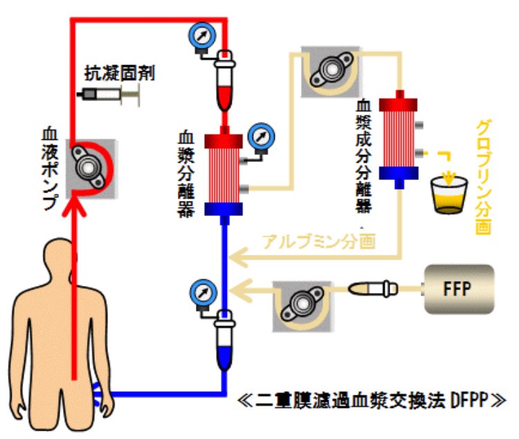 血漿 交換