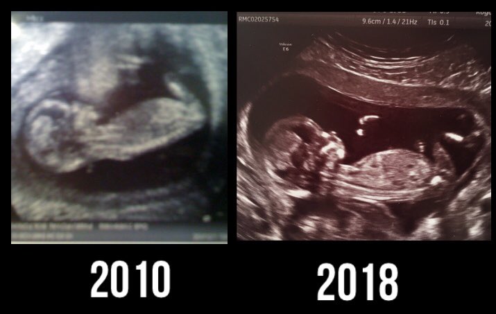 HealWithRachel's tweet image. Boy or Girl?! Eeeeek we will find out in October !! #babyno2 #familyiseverything 💙👶🏻💗