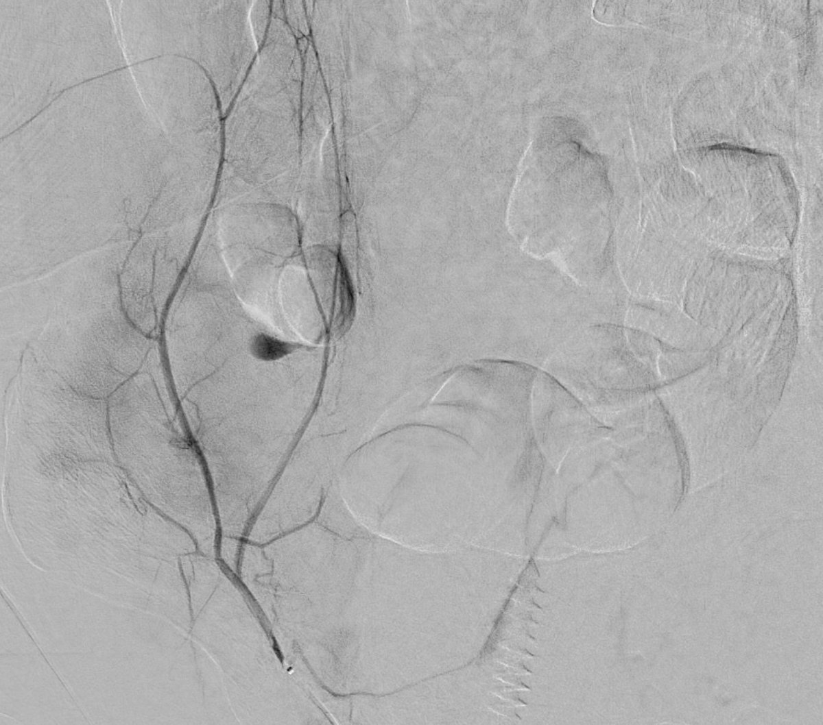 SimaBanerjeeMD's tweet photo. Right abdominal wall bleed post bedside para. Hgb 5, prbc x 5, failed abdominal binder. ICU calls #IRAD. 45 minutes later, subselective angio shows bleed. Tight coil pack woven into bleeding vessel, bleeding stopped. No scar, no pain, no mess. #pinholesurgery https://t.co/ArPAGSPRGv