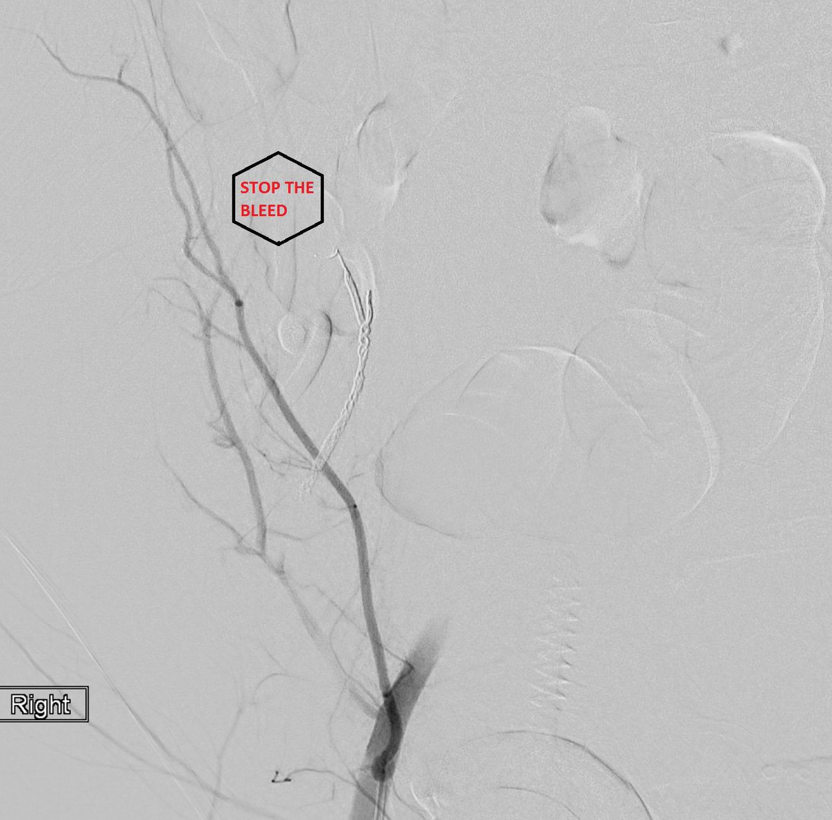 SimaBanerjeeMD's tweet photo. Right abdominal wall bleed post bedside para. Hgb 5, prbc x 5, failed abdominal binder. ICU calls #IRAD. 45 minutes later, subselective angio shows bleed. Tight coil pack woven into bleeding vessel, bleeding stopped. No scar, no pain, no mess. #pinholesurgery https://t.co/ArPAGSPRGv