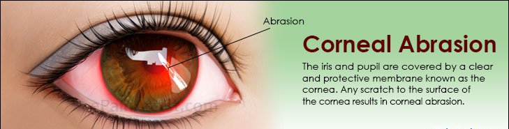 OphthalmoNeuro's tweet photo. #cornealabrasion is one of the most common #eye injuries. A scratched #cornea often causes significant discomfort #redeyes and hypersensitivity to light. 
#ophthalmology #Neurology #VisualSystem #VisualNeuroscience
Share your research under this track https://t.co/ezoIf9g3CN https://t.co/JijHnMhWz1