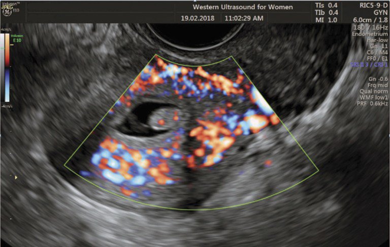 Subfertility Imaging in Women with Dr Emmeline Lee bit.ly/2IoTKAi #subfertility #reducedfertility #infertility #womensimaging #fertility