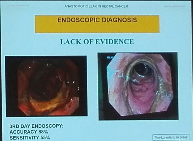 GianlucaPellino's tweet photo. @frasson_matt 

#anastomoticleak #endosponge 
#rnaec2018 
#colorectalsurgery https://t.co/fIfqKRVFfU