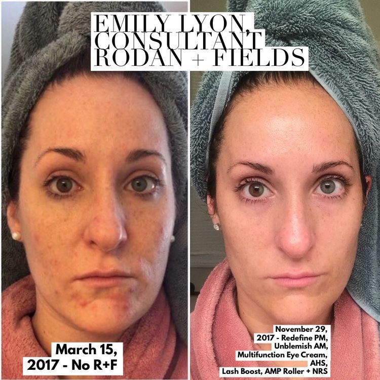 chasekenslee's tweet photo. Unblemish!!!!   Don’t let acne rule your life.... https://t.co/azagUlehkq