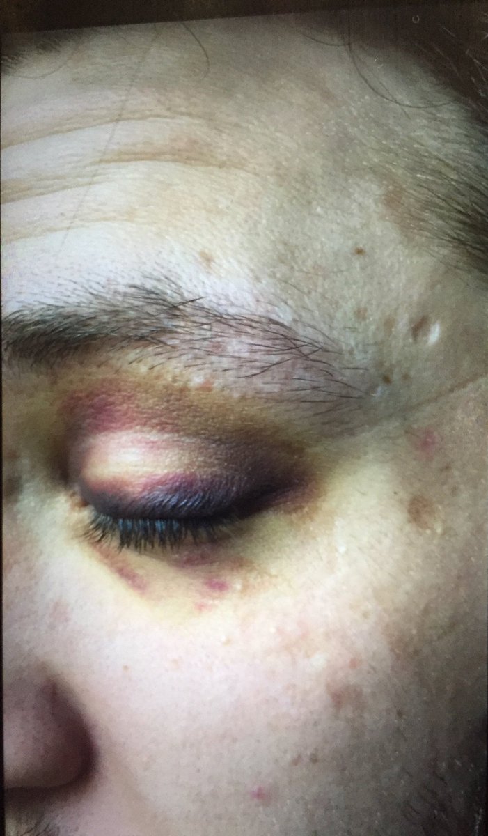 Indians_Tolosa's tweet photo. Un de nos membres interpellé lors de la charge de la SIR/BAC de dimanche passe au tribunal cet après-midi. Nous vous laissons constater par vous-même les blessures qu'il s'est "fait tout seul en tombant"... https://t.co/0aEZFotGHs