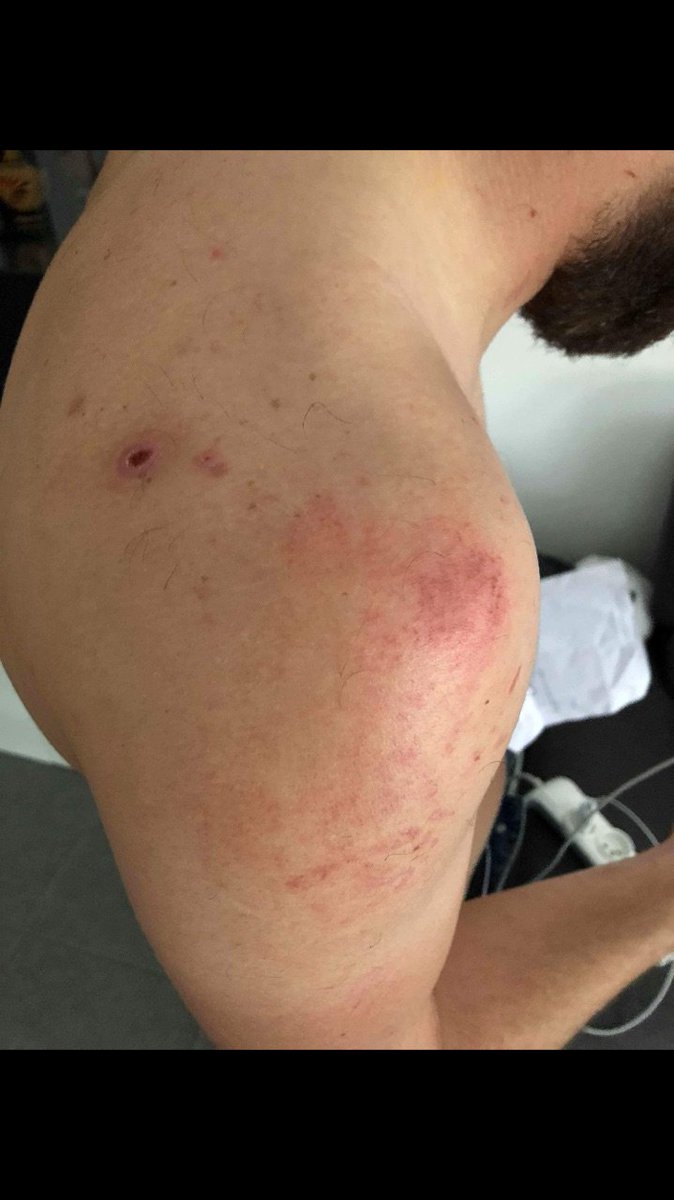 Indians_Tolosa's tweet photo. Un de nos membres interpellé lors de la charge de la SIR/BAC de dimanche passe au tribunal cet après-midi. Nous vous laissons constater par vous-même les blessures qu'il s'est "fait tout seul en tombant"... https://t.co/0aEZFotGHs
