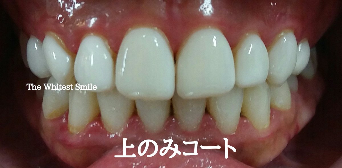 歯のマニキュアホワイトコート専門・歯科 (@Leila_Dental) / X