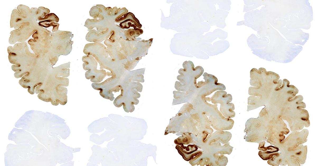 ConcussionCTEfn's tweet photo. Chronic Traumatic Encephalopathy (CTE) is a degenerative brain disease found in athletes, military veterans, and others with a history of repetitive brain trauma. Learn about what #CTE is, the history of the disease, its causes, and much more: 

https://t.co/NkVCI8WDr5 https://t.co/48wrXKdoDD