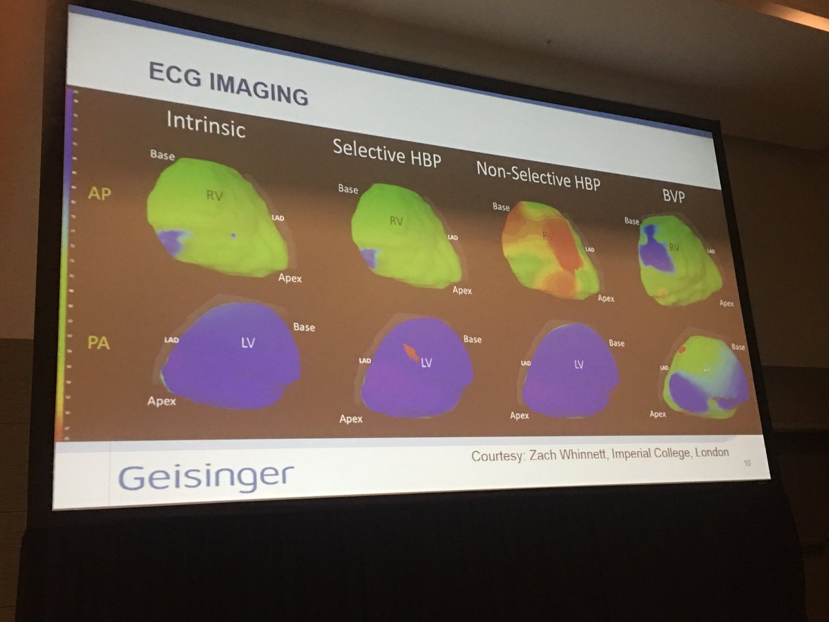 Dr_Keene's tweet photo. Pugal sharing our work: whether selective or nonselective his pacing - lv activation time is not effected #dontdisthehis #ukhispacing https://t.co/yRmPCLE7LD
