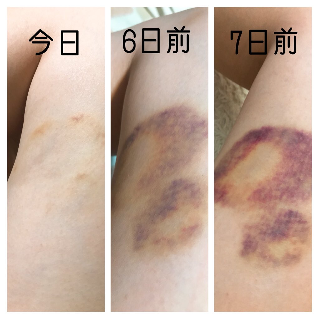 𝔸𝕀 在 Twitter 上 Ku0n Pu えっすごい W 青あざよくできるから使ってみる Twitter