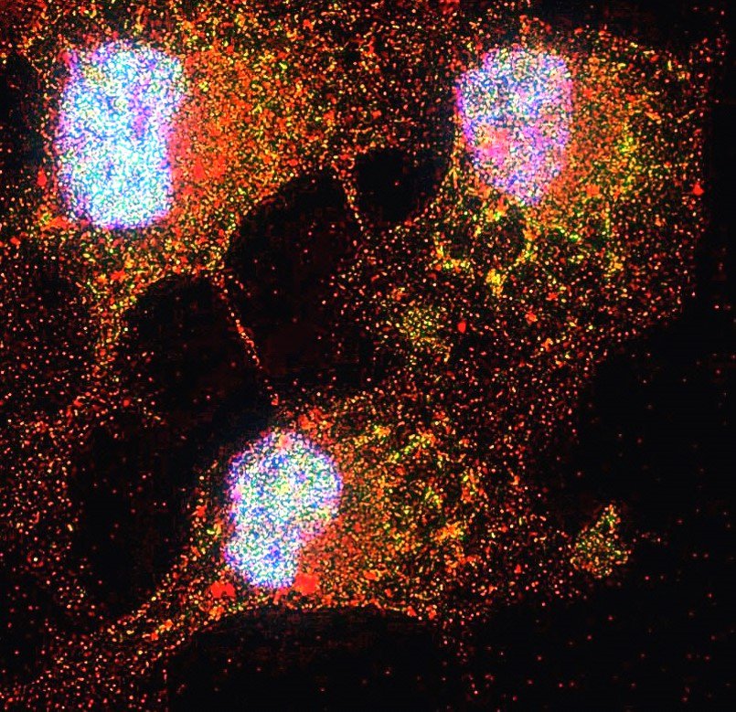 AnaRodWrites's tweet photo. Dr. Padmanabhan and colleagues have determined that #USP15 could be a target in #ovariancancer scientists have been looking for. @bcmhouston @BCMFromtheLabs https://t.co/6MsbuHiTjJ @NatureComms https://t.co/3bLxC6m1zJ