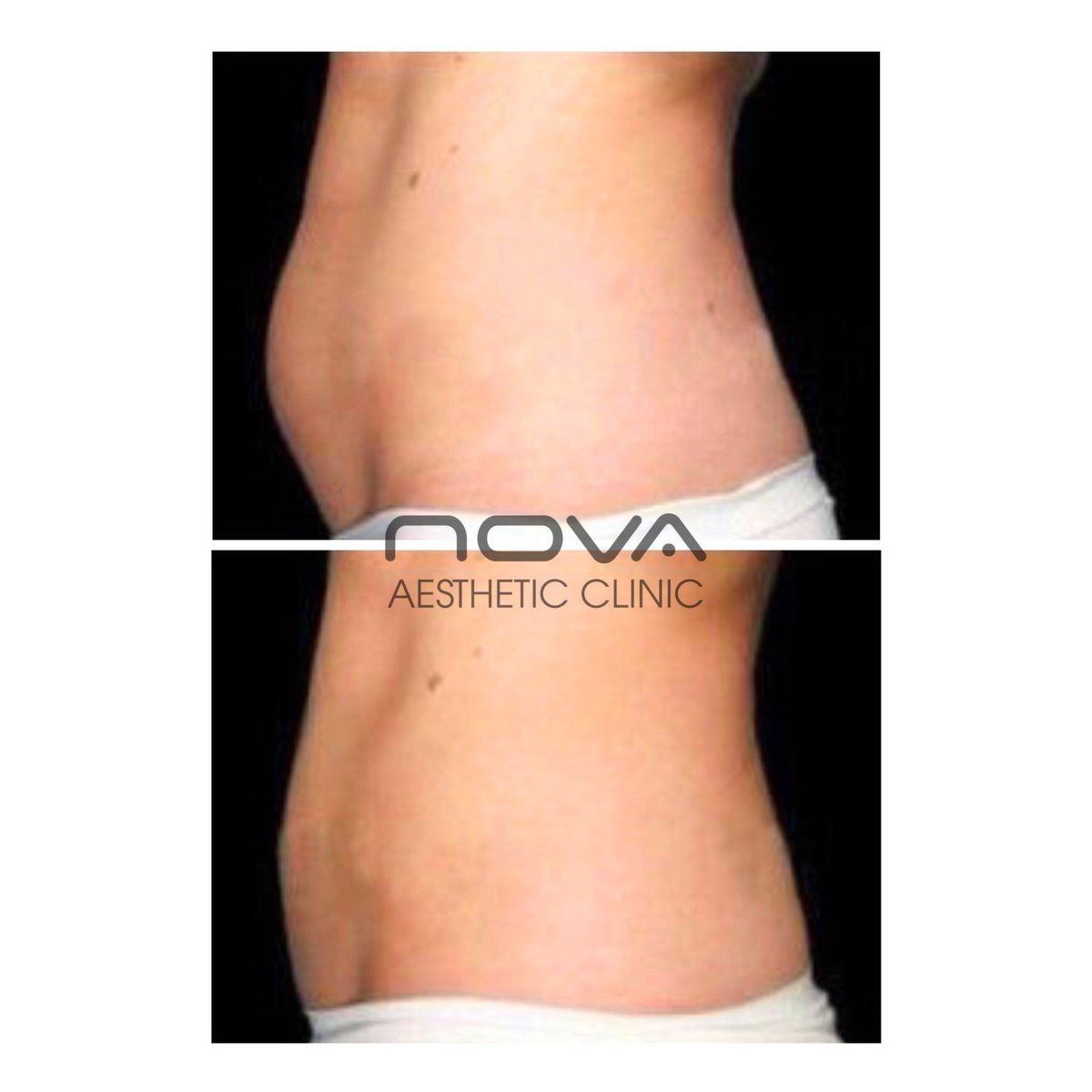 💥FAT FREEZE OFFER at Nova💥 Buy fat freeze body sculpting (Nova LipoFreeze) for one area and get another one completely FREE! Treatment can be carried out within one month but booking MUST be made and deposit paid before Saturday 12th May. #Greenwich #beauty #fatloss #lipofreeze