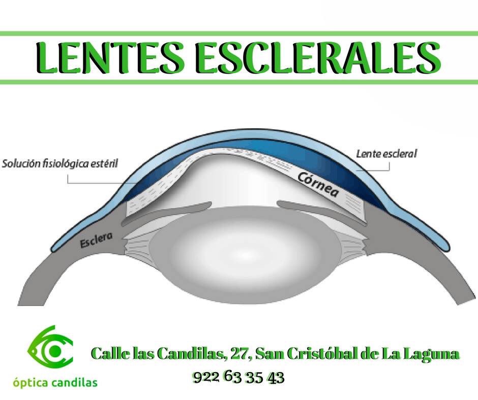 Las LENTILLAS ESCLERALES debido a su tamaño cubren la córnea y se apoyan en la esclera, que al tener menos sensibilidad hace que prácticamente no se noten. Además se acomoda por debajo del párpado, consiguiendo un mejor confort.

Más información en #OpticaCandilas