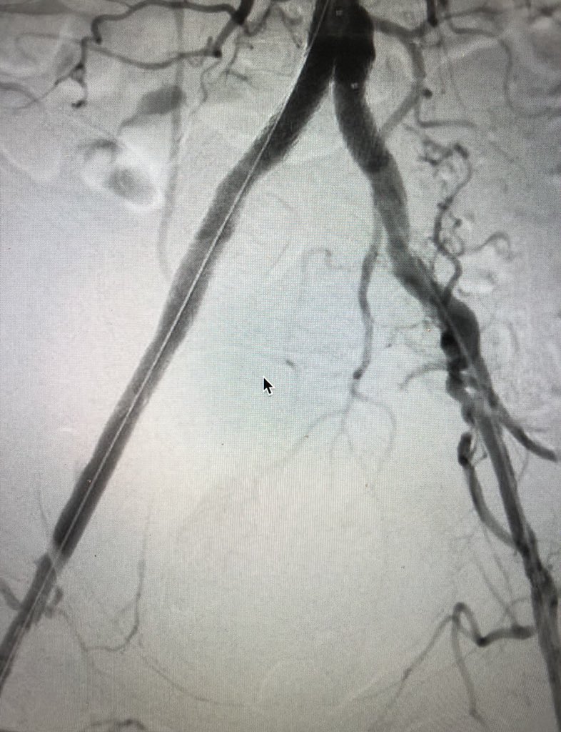 pj_rochon's tweet image. @ColoradoIR #CLIFighters Non-healing wound d/t inflow disease. Re-entry leads to ABI improvement from 0.4 to 1 and 2+ DP. @CLI_Global @kmadass @SDhandMD @KMSchramm @UCD_IR #stopthechop #mylegmylife