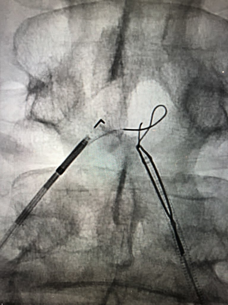 pj_rochon's tweet image. @ColoradoIR #CLIFighters Non-healing wound d/t inflow disease. Re-entry leads to ABI improvement from 0.4 to 1 and 2+ DP. @CLI_Global @kmadass @SDhandMD @KMSchramm @UCD_IR #stopthechop #mylegmylife