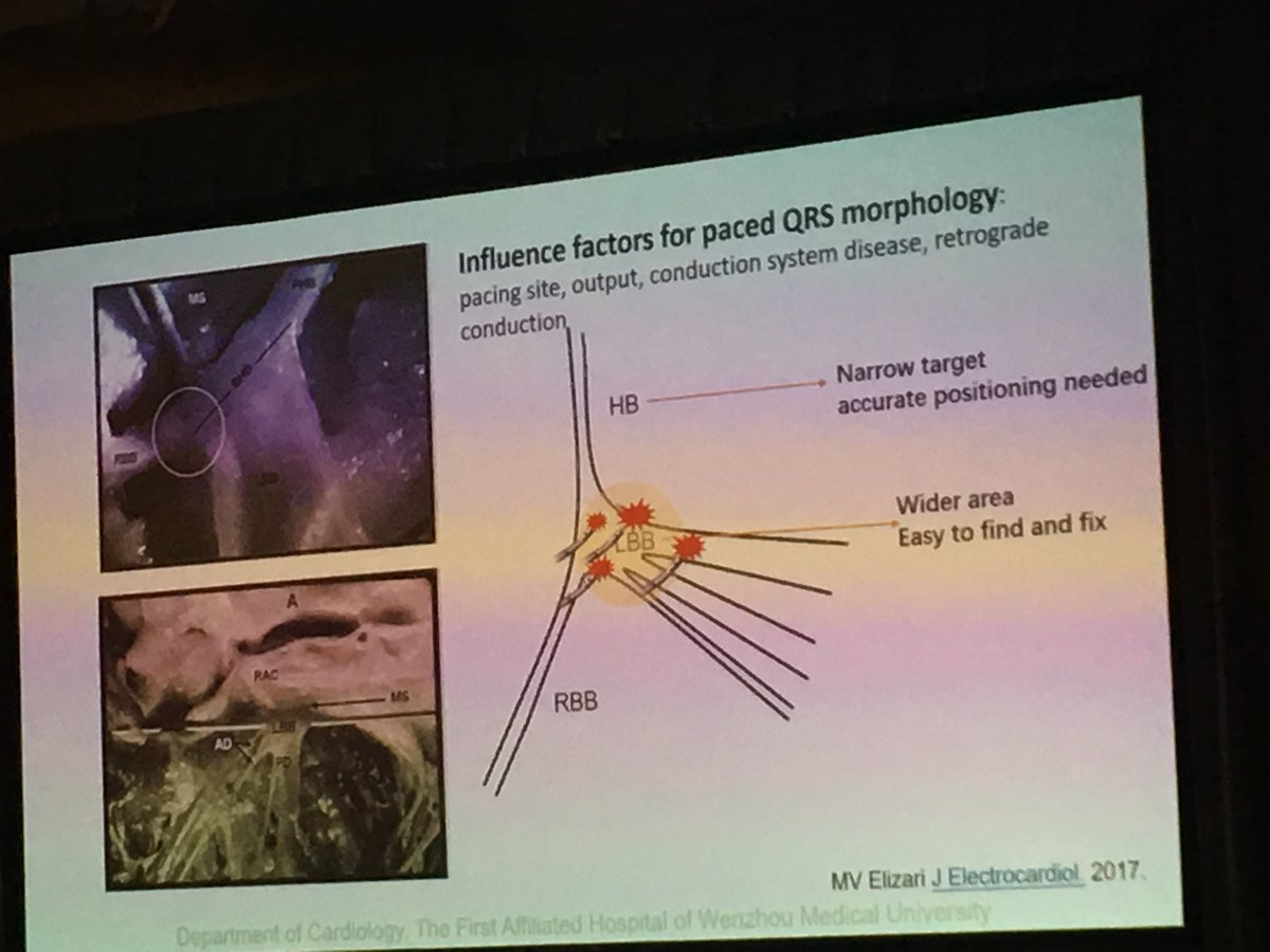 New concept in His bundle pacing - direct LBB pacing. Exciting report from China! Congratulations for Dr. Weijian Huang! #HRS2018 #dontdisthehis