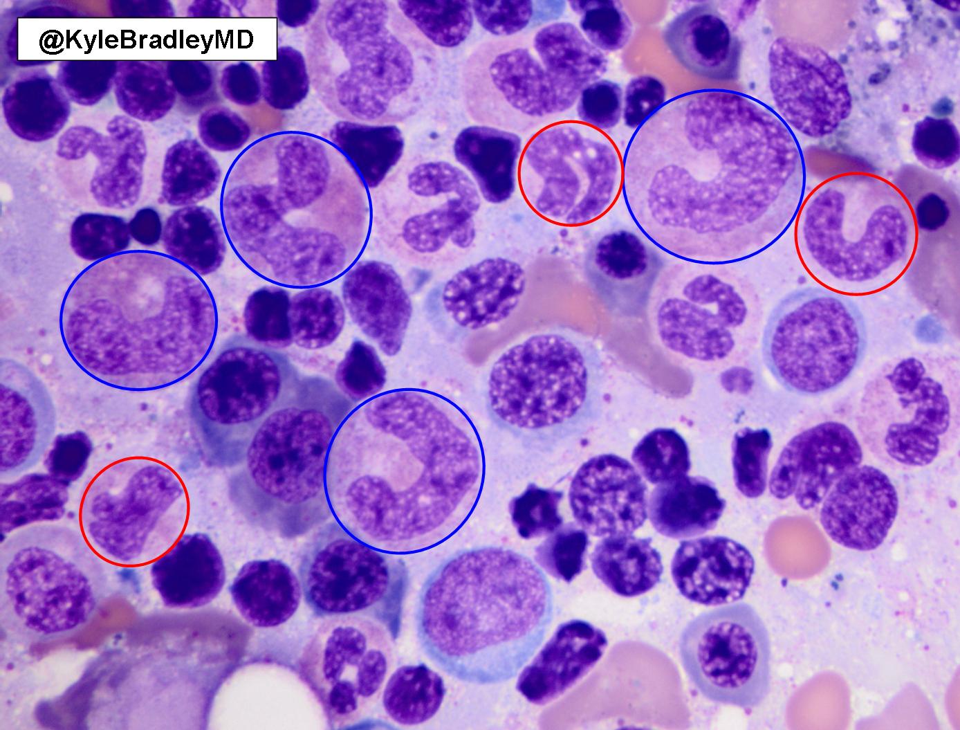 Kyle Bradley, MD on X: Megaloblastic neutrophils in bone marrow. So-called  giant bands and giant metamyelocytes (blue circles) are 1.5-2 times the  size of normal bands and metamyelocytes (red circles).   /