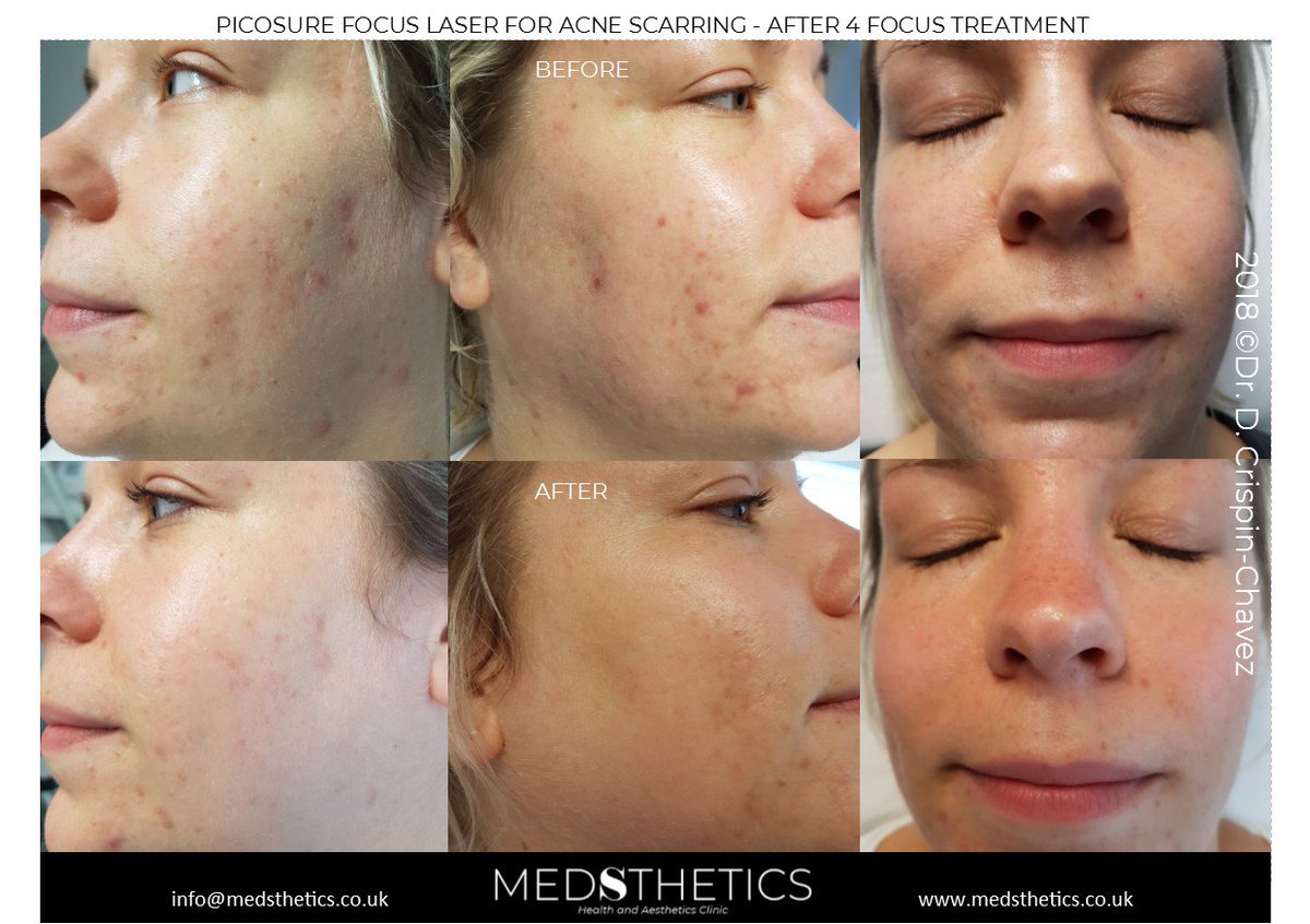 Medsthetics Ltd On Twitter Laser Picosure Focus Treatments For Acne Scarring After 4 Sessions 4 6 Wks Apart Amazing Results