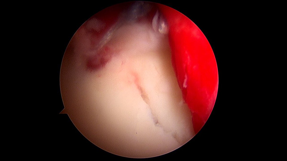 Sportscaduceus's tweet photo. Anterior glenoid fx after shoulder dislocation. L shoulder view from post 70deg scope. Fixed with suture bridge to compress fx @injurypics https://t.co/xNkHYMM5gY