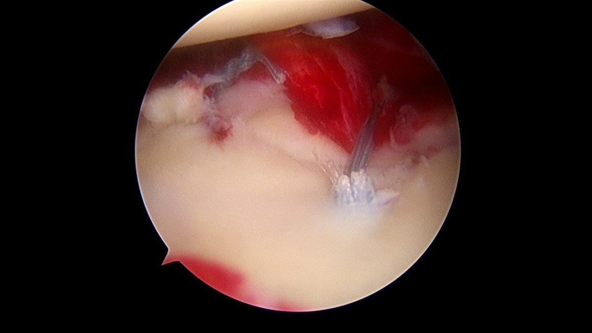 Sportscaduceus's tweet photo. Anterior glenoid fx after shoulder dislocation. L shoulder view from post 70deg scope. Fixed with suture bridge to compress fx @injurypics https://t.co/xNkHYMM5gY