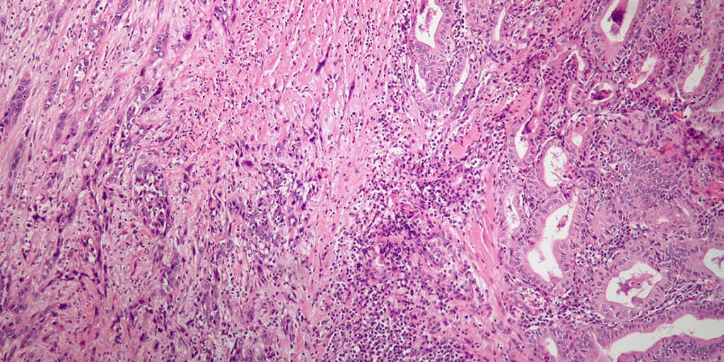 AACR's tweet photo. #ICYMI: On May 4, the U.S. Food and Drug Administration (FDA) approved a combination of molecularly targeted therapeutics for the treatment of a certain type of thyroid cancer. https://t.co/VGrUYUOzrs https://t.co/8mNtbuAFeF