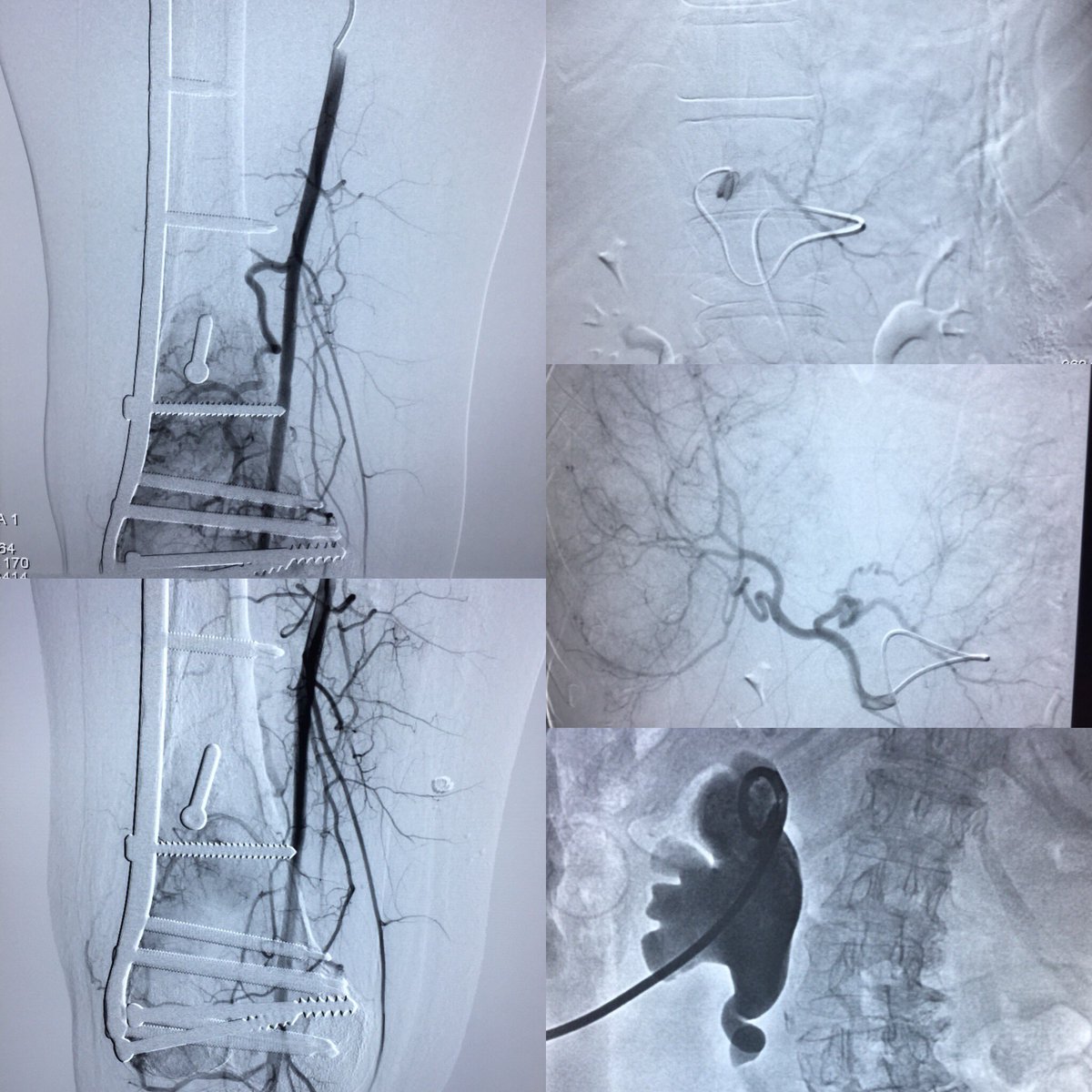 JesusBPMD's tweet photo. Busy week so far! 🤩. - Bone mass embolization. - HCC chemo-embo. - PCN (made by me) under Dr @jlriosr supervision of course! #iamir #pathtoIR #interventionalradiology #IamIR #IloveIR #mentorshipmatters #IRad #SIR #attitude #Thankful https://t.co/rCmgn7PjoH