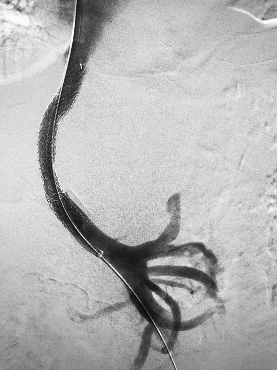 Acute life-threatening upper GI bleeding from varices. #IRad can help with #TIPS and #embolization. <a href="/SIRspecialists/">Society of Interventional Radiology</a> <a href="/SIRRFS/">SIR RFS</a>
