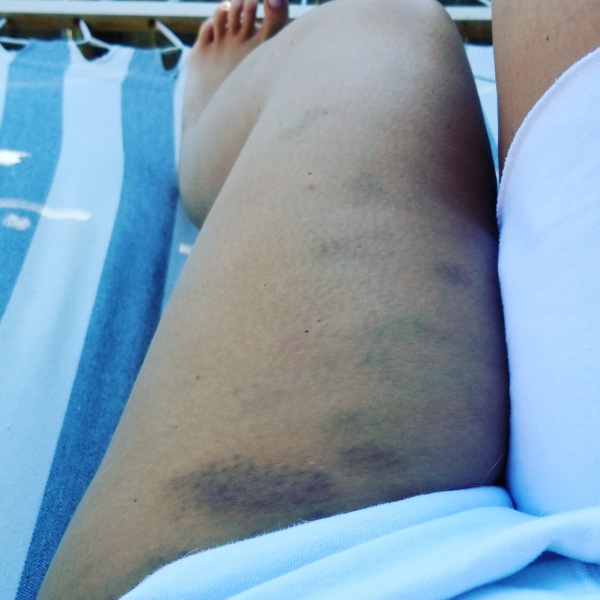 maryrenouf's tweet photo. Get an #alpaca they said... it will be fun they said. #liars #alpacsakick #sonofa #purpleandgreen #swollenlikeamofo #citygirlturnedcountry #farmlife #farminjuries https://t.co/Yy2LlIpFoD