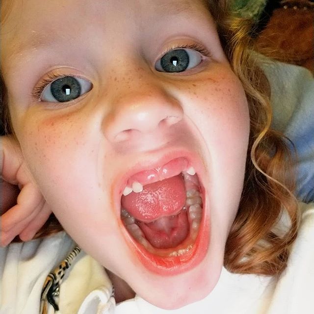 Ehrencongdon's tweet photo. She'll lose another tooth tonight and she's already been toothless for five months. Do they make kid dentures, because I don't think she's got any teeth up in there! https://t.co/RYLlHP3tBc https://t.co/yZhEUt7Jx3