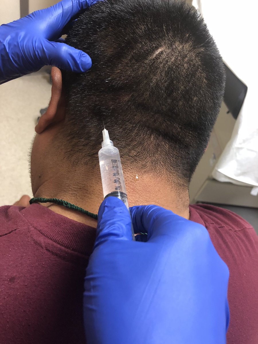 jchristianfox's tweet photo. Google one, Do one, Tweet one #g1d1t1 Occipital nerve block for persistent headache. It worked amazingly fast!! #FOAMed https://t.co/papwzmBh5n https://t.co/kAbRYrRHy0