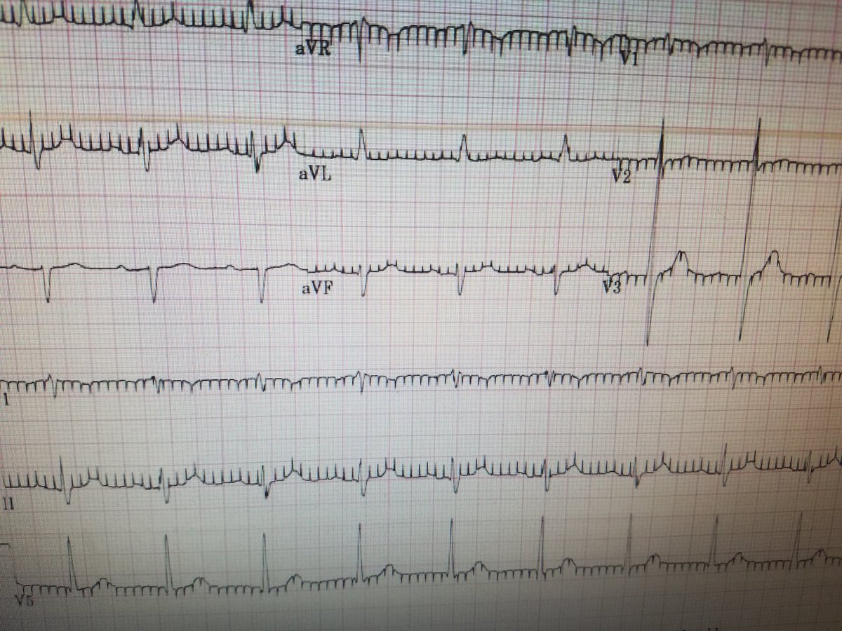 MustafaAhmedMD's tweet photo. Unfortunately real event.

On call, middle of night, stat consult for (asymptomatic) 'heart fibrillation' https://t.co/D5txHh6Xmi