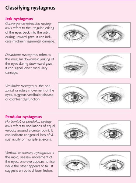 Nystagmus is a vision condition in which the eyes make repetitive, uncontrolled movements. These movements often result in reduced vision and depth perception and can affect balance and coordination
bit.ly/2kjOdgF