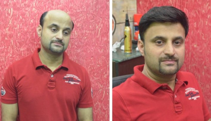 Hair transplant cost in Bangalore  Medlinks