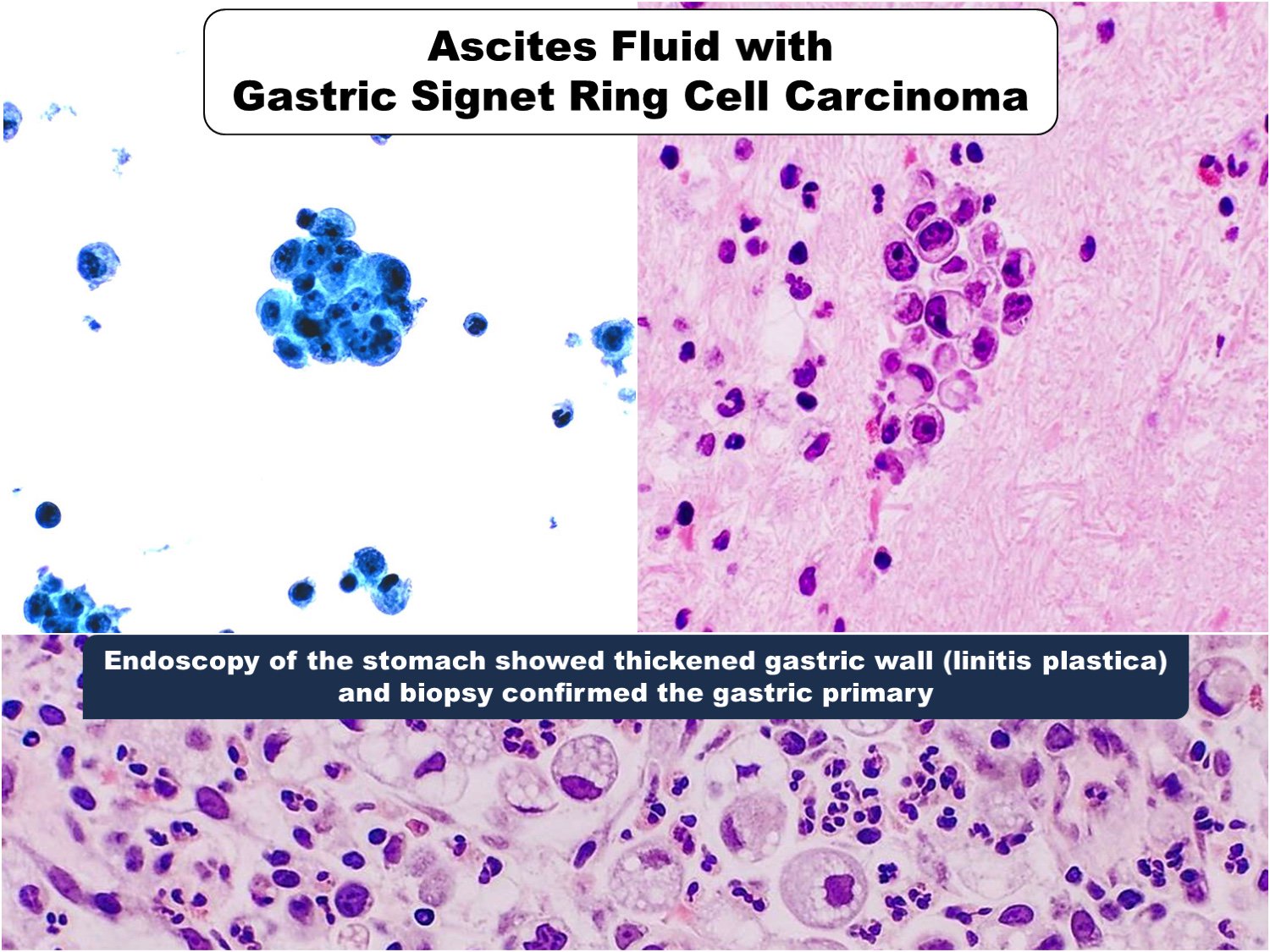 Gastric Signet Ring Cell Carcinoma: Current Management and Future Chal |  CMAR