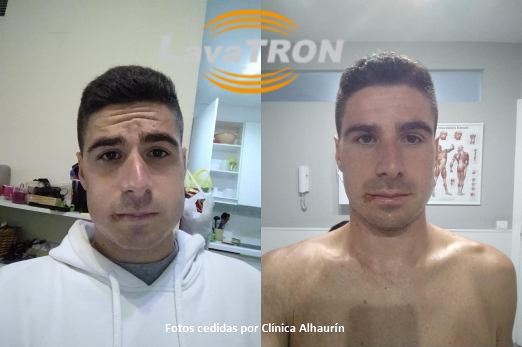 Con la función exclusiva BIODIATERMIA del equipo LavaTRON 250,los resultados son inmediatos y duraderos. En Clínica Alhaurín han realizado un tratamiento de un edema producido por una extracción de tres molares con cirugía.Transcurridas unas horas el resultado es IMPRESIONANTE!!
