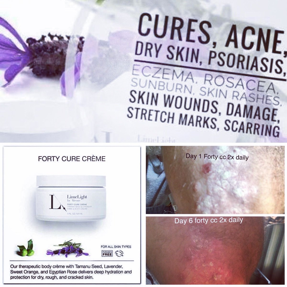 limelife stretch marks