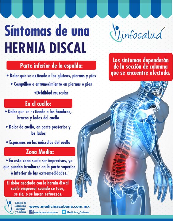 Gestionar Derivación Continuo Cristina Molina Fisioterapia en Twitter: "¿Conoces los síntomas de una hernia  discal? #salud #hernia #fisioterapia #lesiones #dolor #FelizJueves  https://t.co/NVy0GwWtMR" / Twitter