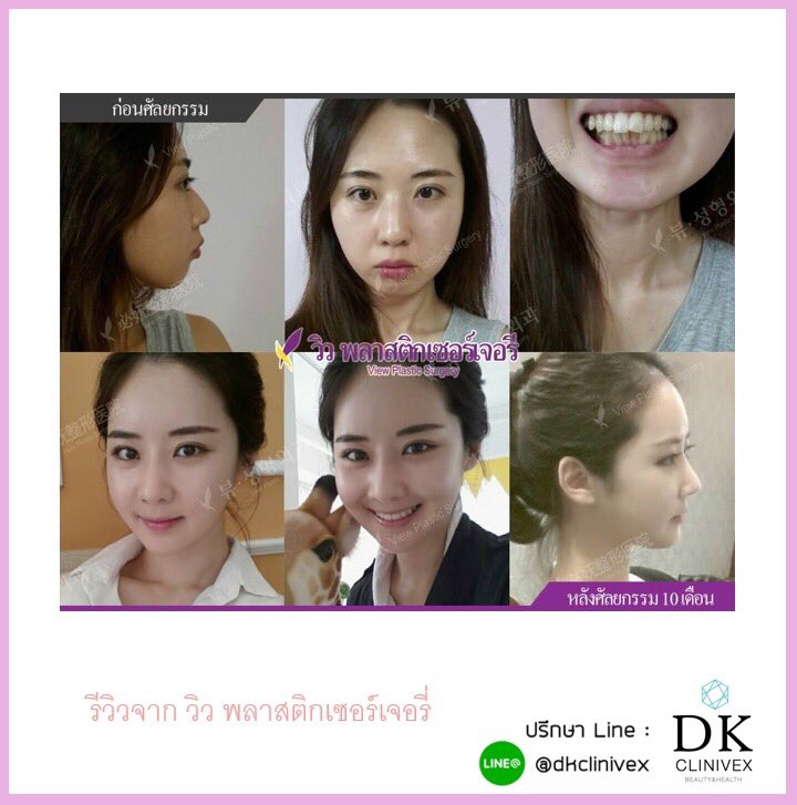 dkclinivex's tweet photo. 💖จากสาวหน้าตาที่ธรรมดา กลายเป็นสาวน้อยหน้าใส ที่มีใบหน้าคล้ายกับนักร้องไอดอลชื่อดัง ซอฮยอน Girl’s generation หรือ โซนยอชิแด Snsd 

👑✨อยากพัฒนาตัวเองเสริมสร้างความมั่นใจ ปรึกษาพวกเราได้ตลอด 24 ชั่วโมง ยินดีดูแลทุกท่าน และตอบปัญหาให้กระจ่างทุกข้อ สอบถามได้ที่ Line : @dkclinivex https://t.co/gMQw2qFuVH