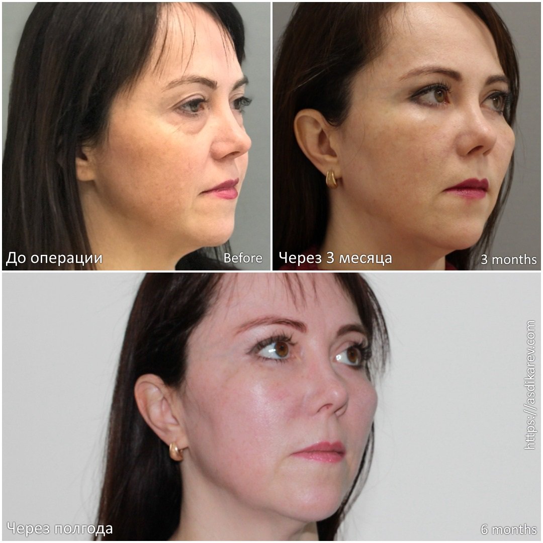 Липофилинг средней трети лица