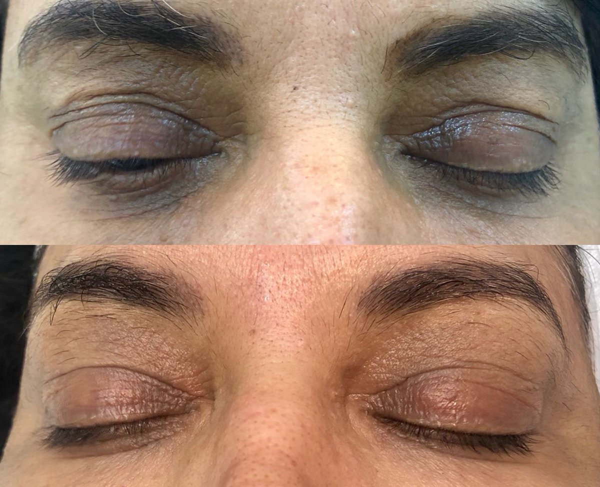 carboxy under eye treatment