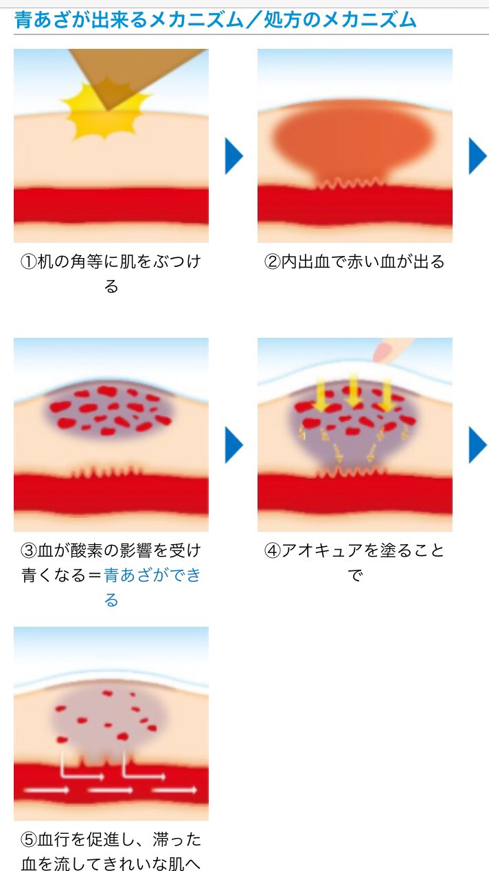 すずたん 渡韓待ち Ar Twitter こ これは 色んな手術後に使えるじゃないか 内出血 腫れ ケガによる傷跡 火傷に効くなんて最 高 こんな薬が発売されたなんて やるな小林製薬 脂肪吸引とかかなり内出血するし 色んなダウンタイムに使えそう
